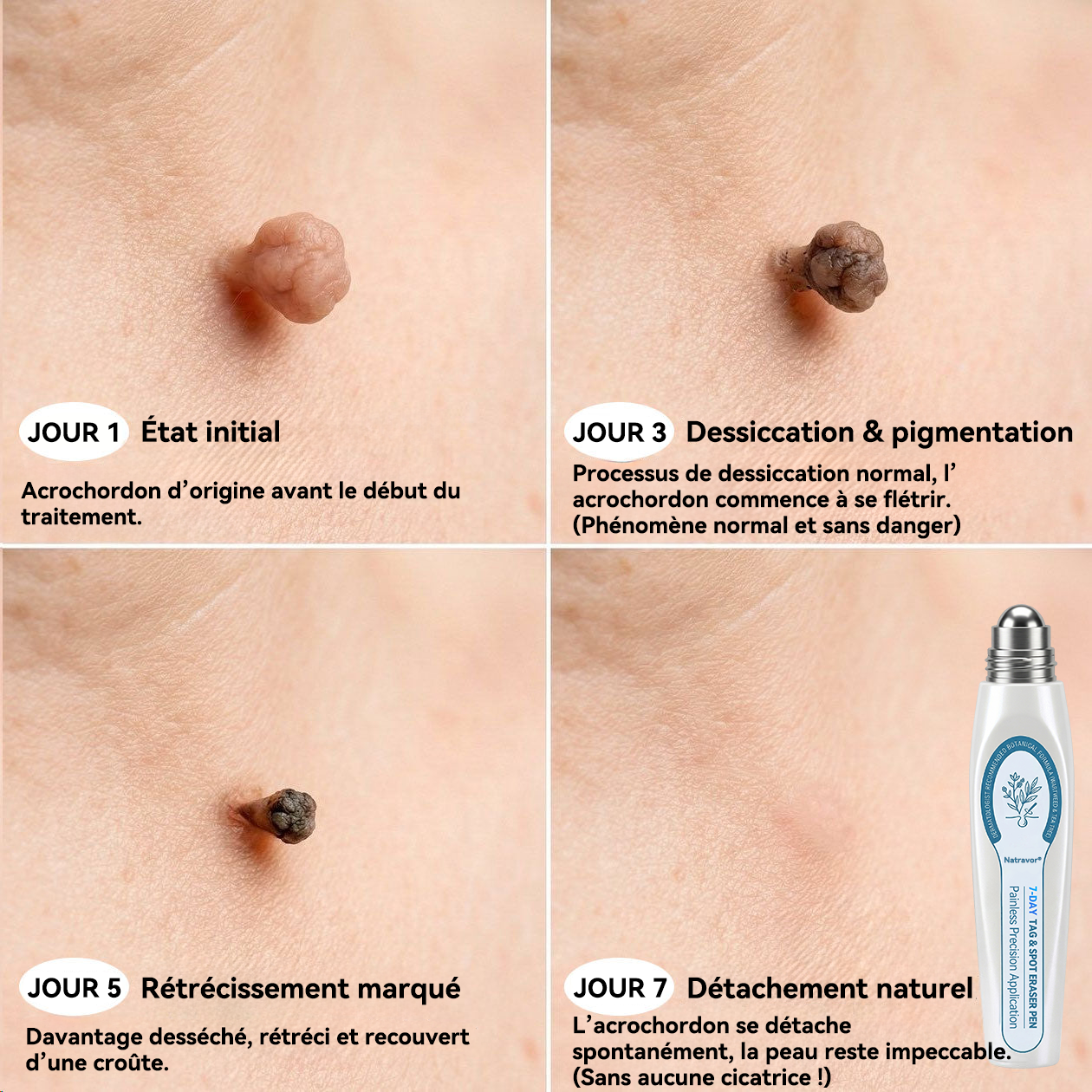 🎁 Plus que 5 disponibles ! Profitez de -50 % aujourd’hui ! Éliminez les acrochordons indésirables et retrouvez une peau plus lisse. Ne ratez pas cette offre exclusive : la prochaine chance sera l’année prochaine !